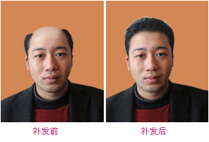 <em>脱发怎么办</em>?秃顶<em>怎么办</em>?<em>头发</em>稀少<em>怎么办</em>如何