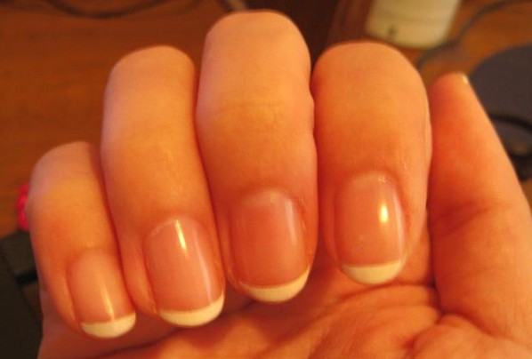 上海灰指甲治疗中心_得了灰指甲怎么办\/灰指甲