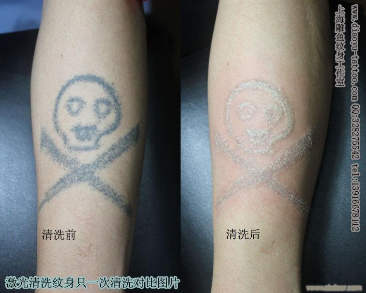 上海清洗纹身哪里 价格 具体地址