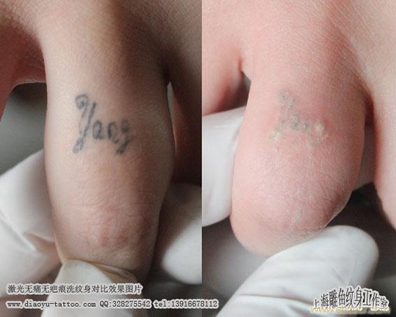 上海闵行区激光无痛无疤痕清洗纹身哪里洗的最干净