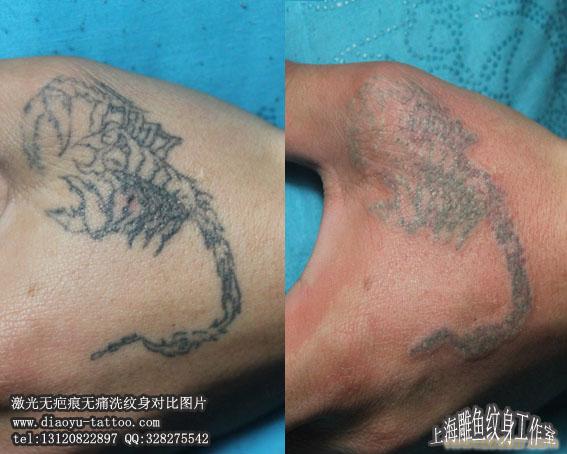 上海闵行区激光无痛无疤痕清洗纹身哪里洗的最干净