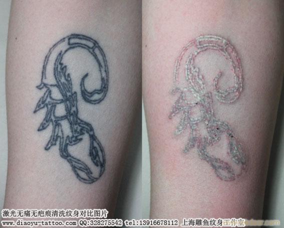 上海洗纹身价格洗纹身多少钱