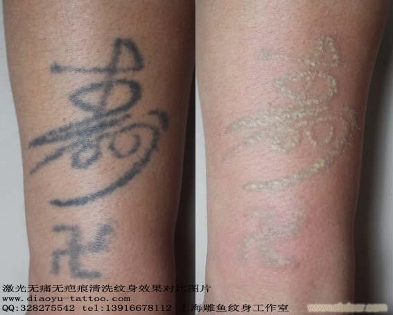 上海激光洗纹身哪家医院，价格还不贵，闵行区的