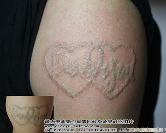 上海洗纹身 请问激光洗纹身到底能洗的干净吗