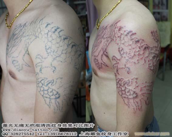 上海洗纹身 上海洗纹身店