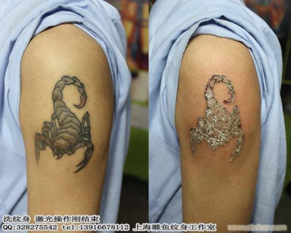 上海浦东新区洗纹身哪里做的