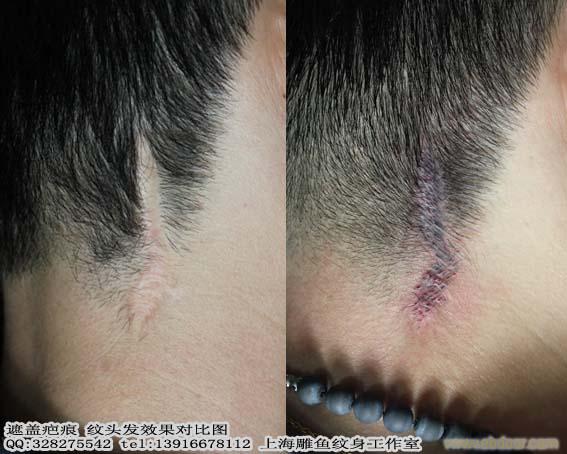 上海修改疤痕遮盖疤痕纹身哪里做的