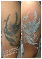 上海市徐汇区桂林路专业洗纹身店