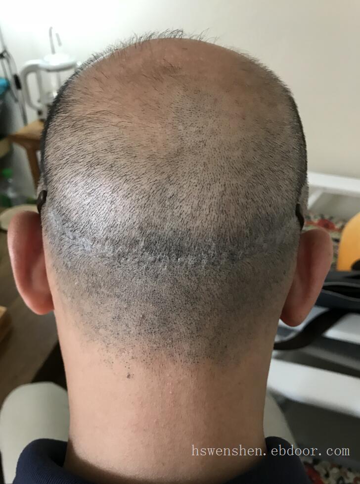 纹发纹头发纹早期植发后留下的取发刀口疤痕