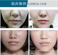 德玛莎一代水光仪器多少钱