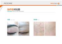 洗眉机订做 洗眉机贴牌 洗眉机批发价格 祛斑