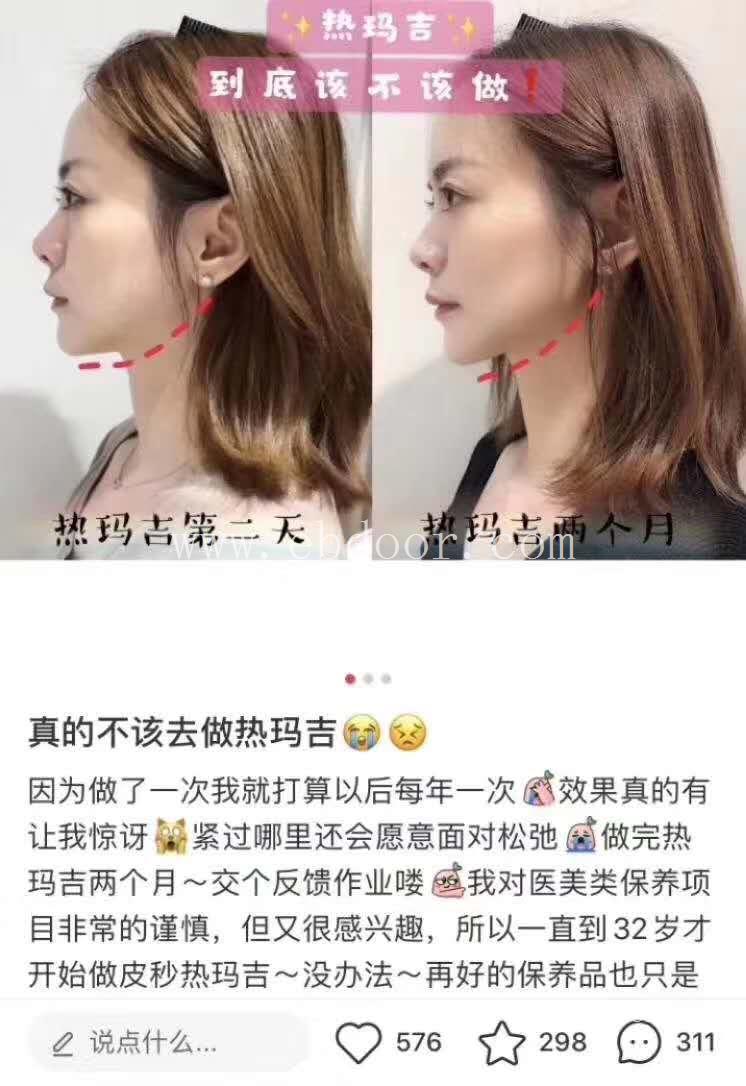 热玛吉5代做一次多少钱 热玛吉5代