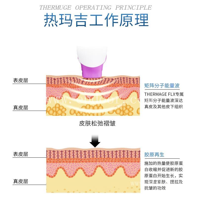 美容院用热玛吉是什么仪器 第五代热玛吉的效果