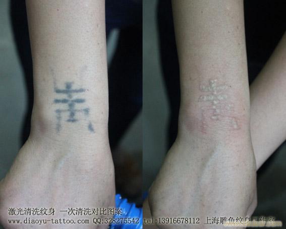 上海清洗纹身哪里最好最专业 具体地址 价格_
