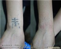 上海清洗纹身哪里最专业 具体地址 价格