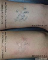 上海闵行区莘庄附近激光清洗纹身哪里最专业纹身价格具体地址